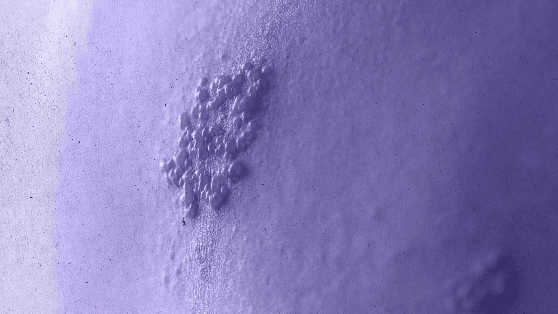 Herpes Zoster: виклик для інфекціоніста та невролога